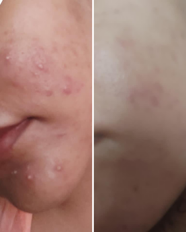 Vitamin C & E Serum (Anti Acne+Anti-Aging+Anti-Hyperpigmentation)